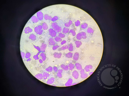 PLASMA CELL LEUKEMIA 2