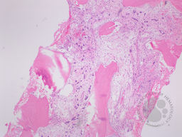 Invasive Ductal Carcinoma in Bone Marrow 1