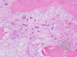 Invasive Ductal Carcinoma in Bone Marrow 2