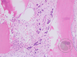 Invasive Ductal Carcinoma in Bone Marrow 3