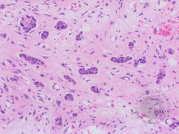 Invasive Ductal Carcinoma in Bone Marrow 4