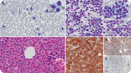 AML, myelodysplasia related, with STAG2 and SRSF2 comutations with myelocyte arrest