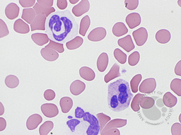 Dysgranulopoiesis 1