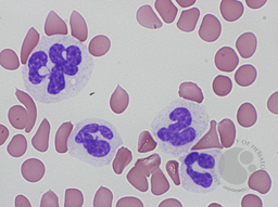 Dysgranulopoiesis 2