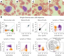 Circulating composite B- and T-cell lymphoma