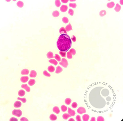 Myeloblast in Peripheral Blood Smear