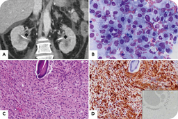 Erdheim-Chester disease in a patient with multiple myeloma