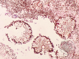 Nasal Aspergillosis (Conidia) in a Post-COVID19 patient with topical steroid overuse
