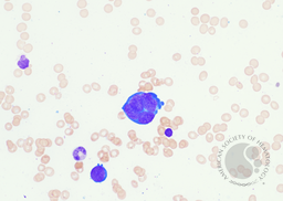 Erythroid dysplasia 1