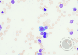 Erythroid dysplasia 2