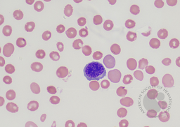 E- Polychromatic erythroblast