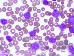 Chronic Lymphocytic Leukemia with trisomy 12 1
