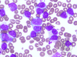Chronic Lymphocytic Leukemia with trisomy 12 3