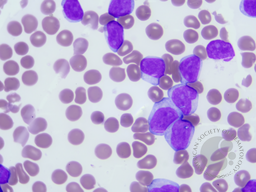 Chronic Lymphocytic Leukemia with trisomy 12 4