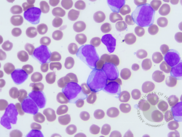 Chronic Lymphocytic Leukemia with trisomy 12 5