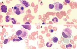 Typhoidal cells: unraveling the diagnostic conundrum in brucellosis instead
