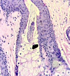 Demodex Folliculorum in scalp biopsy, planned for hair transplantation