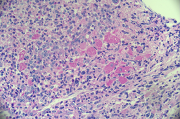 CML with pseudogaucher cells 2