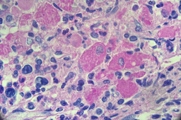 CML with pseudogaucher cells 3