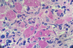 CML with pseudogaucher cells 4