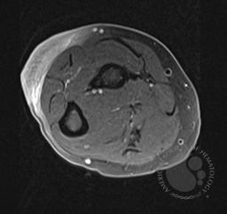 BPDCN and CMML - MRI forearm