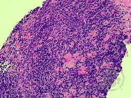 BPDCN and CMML - skin core biopsy