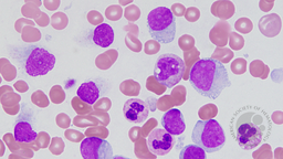 BPDCN and CMML - bone marrow aspirate 2