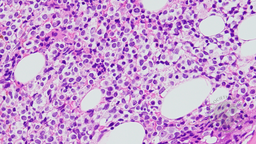 BPDCN and CMML - bone marrow trephine