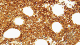 BPDCN and CMML - CD4 immunostain of bone marrow trephine