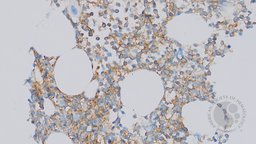 BPDCN and CMML - CD123 immunostain of bone marrow trephine