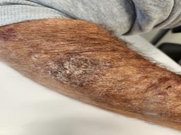 BPDCN and CMML - right forearm after chemotherapy