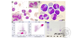 A Tale of Primary Plasma Cell Leukemia in Young