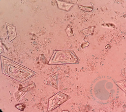 Cholesterol Crystals in Urine Sediment of an adult male