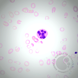 Hypersegmented Neutrophil