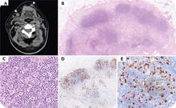 ALK-positive anaplastic large cell lymphoma, Hodgkin-like pattern with unexplained fever