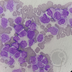 Acute promyelocytic leukemia hypogranular variant