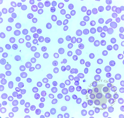 Ring form of Plasmodium falciparum