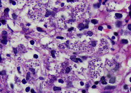 Leishman-Donovan bodies on bone trephine 2