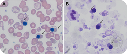 A rare glimpse of Fessas bodies in a patient with β-thalassemia major postsplenectomy