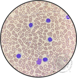 Hairy Cell Leukemia.1