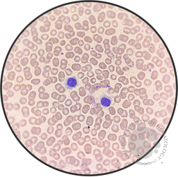 Hairy Cell Leukemia.2