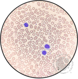 Hairy Cell Leukemia.3