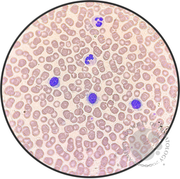 Hairy Cell Leukemia.4