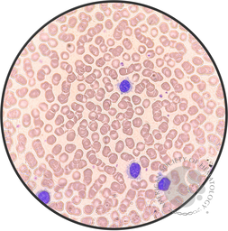 Hairy Cell Leukemia.5