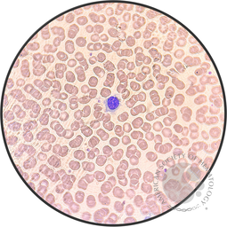 Hairy Cell Leukemia.6