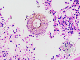 Invasive Aspergillosis in bone marrow 1