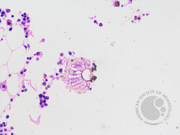 Fruiting Bodies of Aspergillus in bone marrow