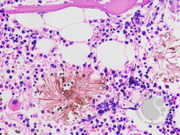 Invasive Aspergillosis in bone marrow 2