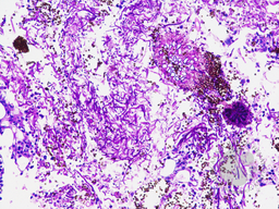 Invasive Aspergillosis in bone marrow - PAS stain 1