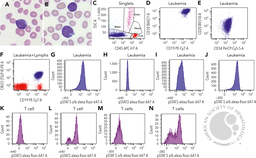 Constitutive STAT5 activation in precursor B-cell acute lymphoblastic leukemia with P2RY8::CRLF2 fusion
